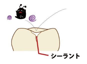 シーラントで歯の溝を埋めた状態(乳歯の断面図)